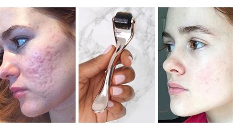 Dermarolling Before and After Pics .